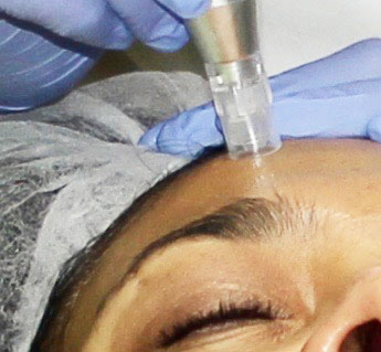 Microneedling-Behandlung