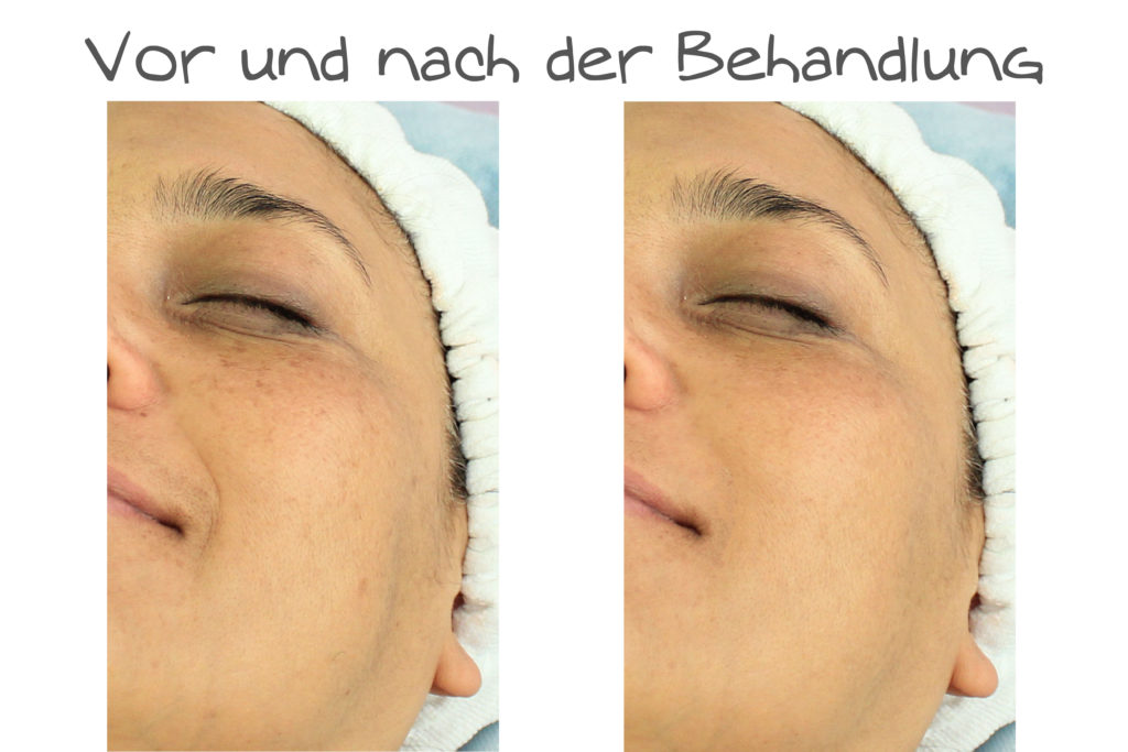 Microneedling Behandlung